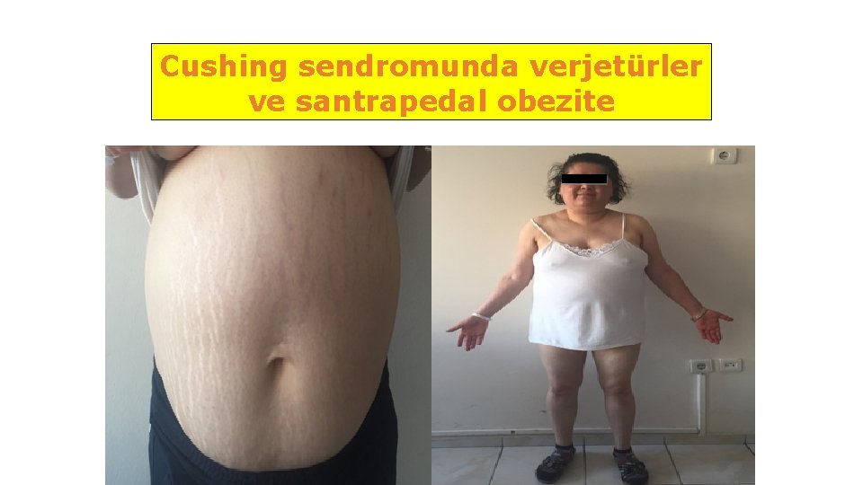 Cushing sendromunda verjetürler ve santrapedal obezite 