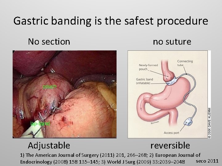 Gastric banding is the safest procedure No section no suture Adjustable reversible 1) The