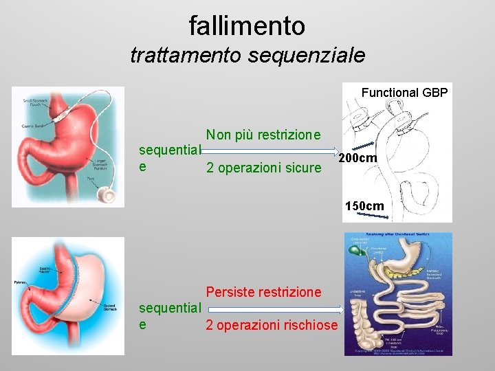 fallimento trattamento sequenziale Functional GBP Non più restrizione sequential e 2 operazioni sicure 200