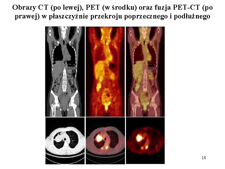 Obrazy CT (po lewej), PET (w środku) oraz fuzja PET-CT (po prawej) w płaszczyźnie