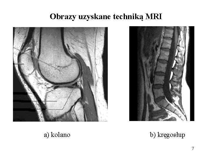 Obrazy uzyskane techniką MRI a) kolano b) kręgosłup 7 