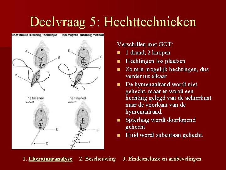 Deelvraag 5: Hechttechnieken Verschillen met GOT: n 1 draad, 2 knopen n Hechtingen los