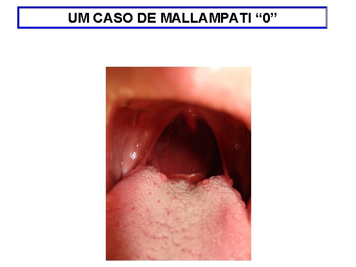 UM CASO DE MALLAMPATI “ 0” 