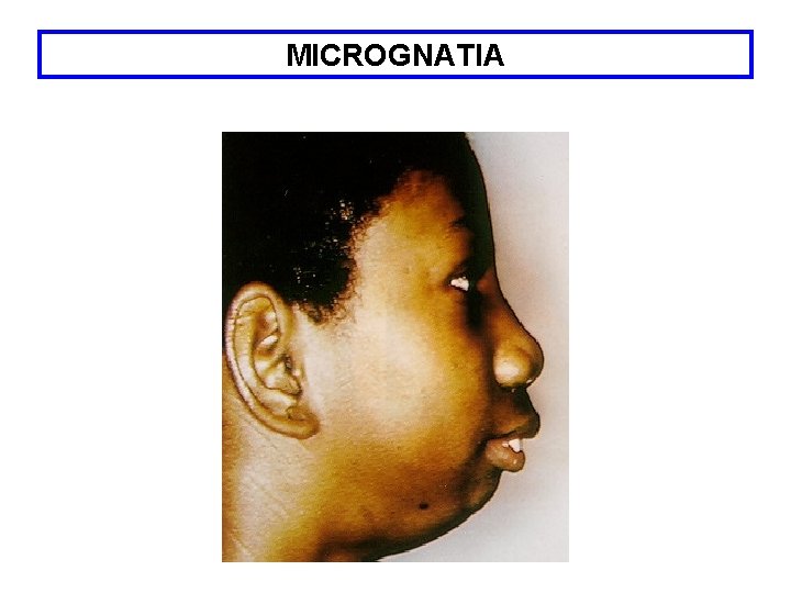 MICROGNATIA 