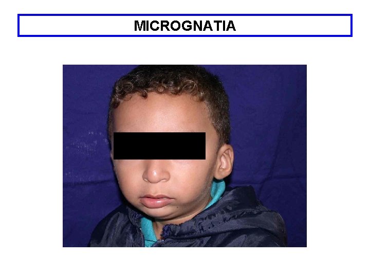 MICROGNATIA 