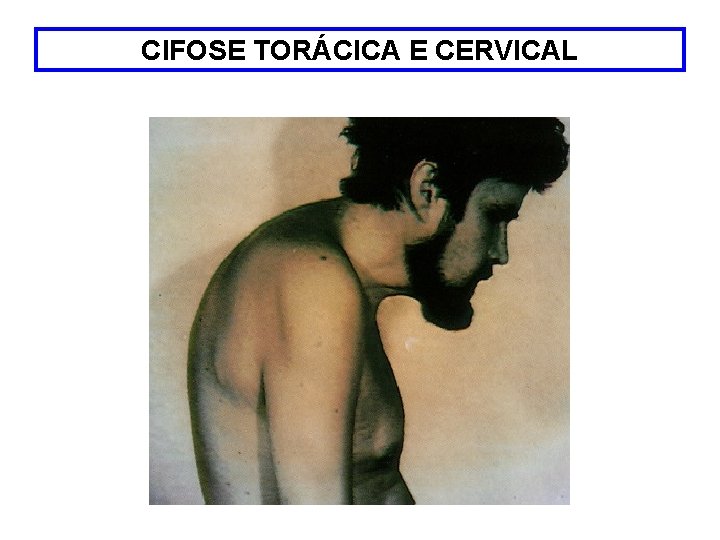 CIFOSE TORÁCICA E CERVICAL 