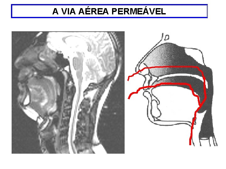 A VIA AÉREA PERMEÁVEL 