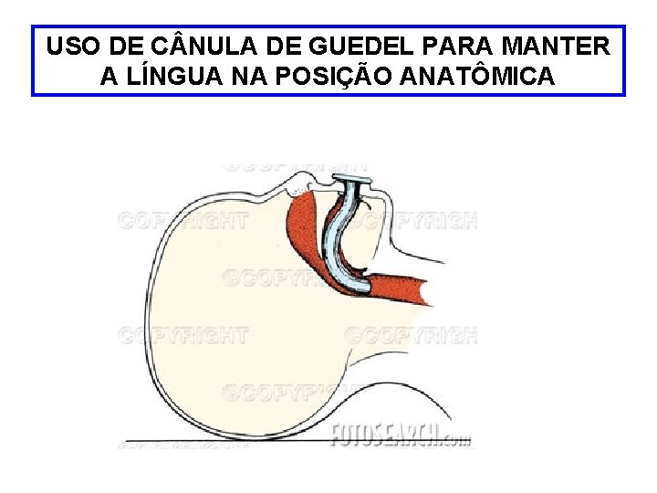 USO DE C NULA DE GUEDEL PARA MANTER A LÍNGUA NA POSIÇÃO ANATÔMICA 