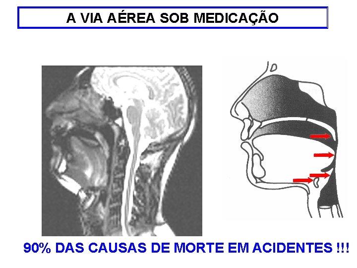 A VIA AÉREA SOB MEDICAÇÃO 90% DAS CAUSAS DE MORTE EM ACIDENTES !!! 