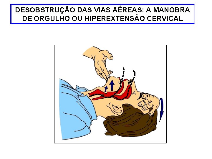 DESOBSTRUÇÃO DAS VIAS AÉREAS: A MANOBRA DE ORGULHO OU HIPEREXTENSÃO CERVICAL 