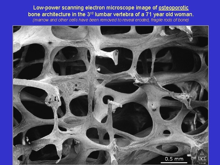Low-power scanning electron microscope image of osteoporotic bone architecture in the 3 rd lumbar