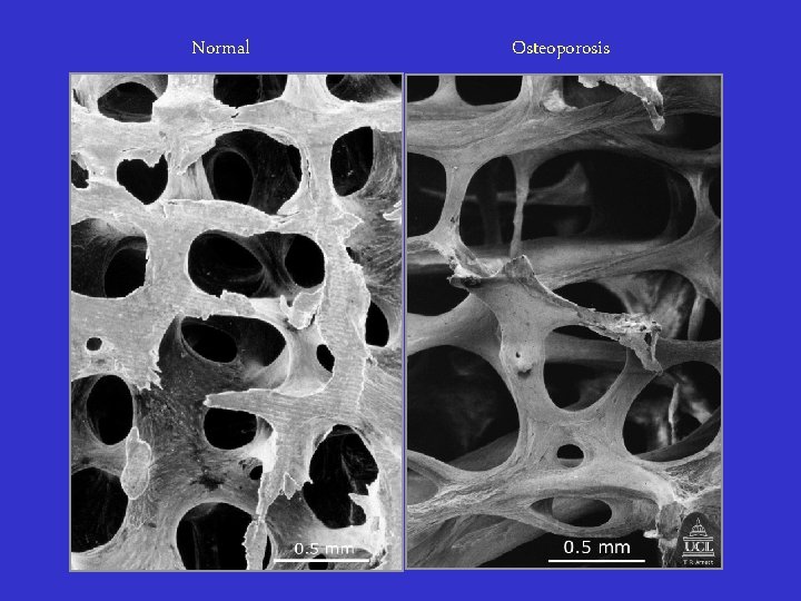 Normal Osteoporosis 