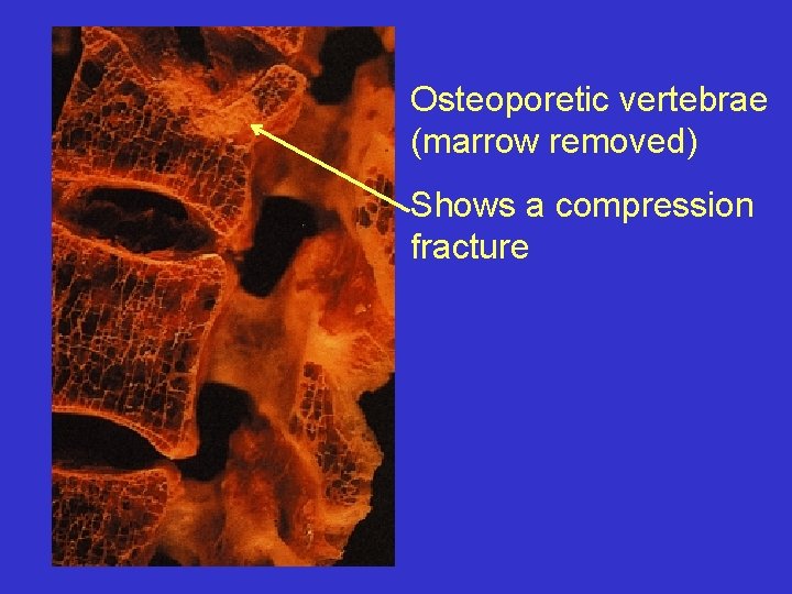 Osteoporetic vertebrae (marrow removed) Shows a compression fracture 