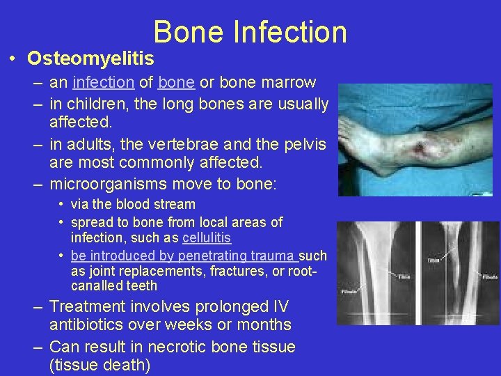 Bone Infection • Osteomyelitis – an infection of bone or bone marrow – in