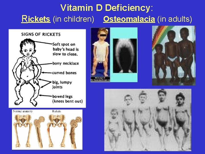 Vitamin D Deficiency: Rickets (in children) Osteomalacia (in adults) 