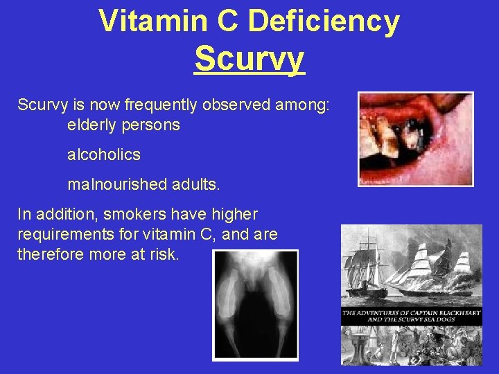 Vitamin C Deficiency Scurvy is now frequently observed among: elderly persons alcoholics malnourished adults.