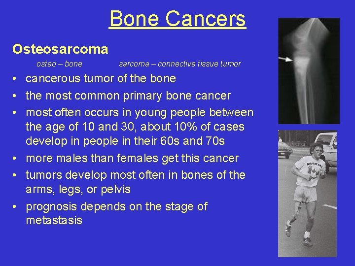 Bone Cancers Osteosarcoma osteo – bone sarcoma – connective tissue tumor • cancerous tumor