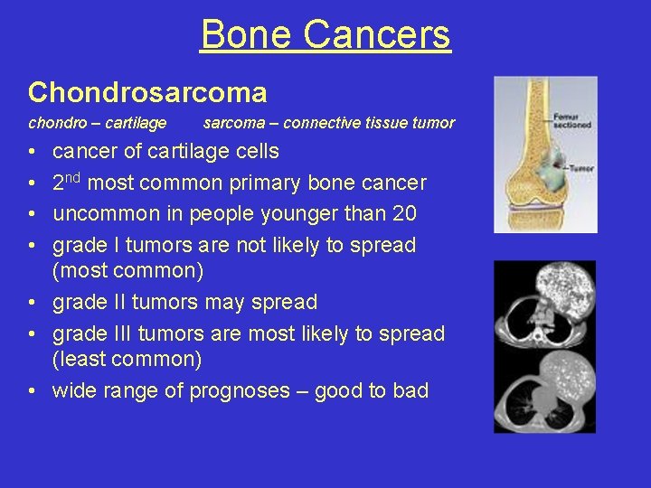 Bone Cancers Chondrosarcoma chondro – cartilage • • sarcoma – connective tissue tumor cancer