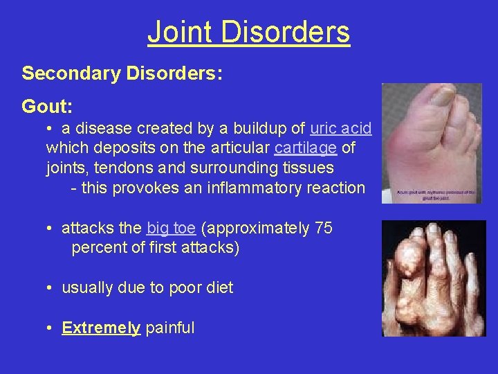 Joint Disorders Secondary Disorders: Gout: • a disease created by a buildup of uric