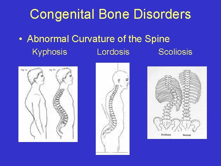 Congenital Bone Disorders • Abnormal Curvature of the Spine Kyphosis Lordosis Scoliosis 