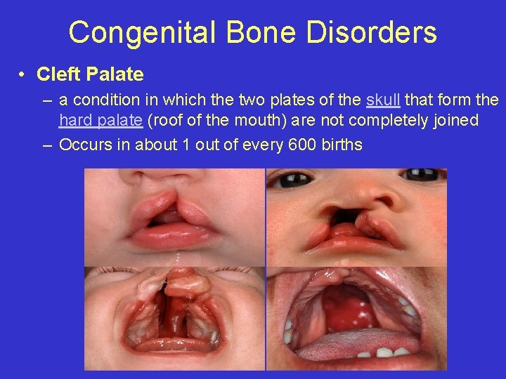 Congenital Bone Disorders • Cleft Palate – a condition in which the two plates