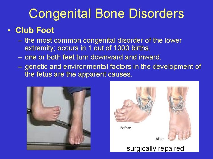 Congenital Bone Disorders • Club Foot – the most common congenital disorder of the