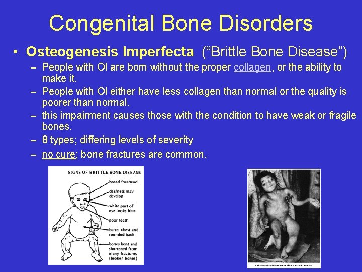 Congenital Bone Disorders • Osteogenesis Imperfecta (“Brittle Bone Disease”) – People with OI are