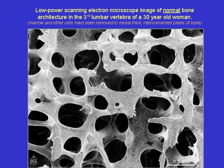 Low-power scanning electron microscope image of normal bone architecture in the 3 rd lumbar