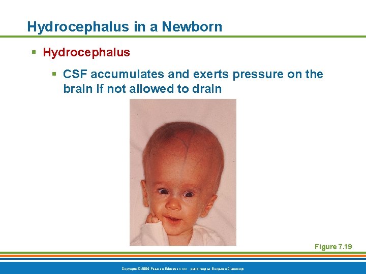 Hydrocephalus in a Newborn § Hydrocephalus § CSF accumulates and exerts pressure on the