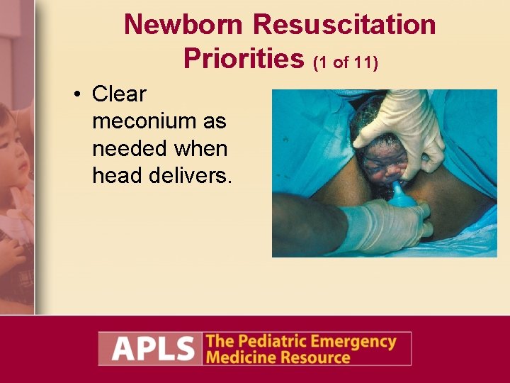 Newborn Resuscitation Priorities (1 of 11) • Clear meconium as needed when head delivers. Newborn Resuscitation Priorities (1 of 11) • Clear meconium as needed when head delivers.