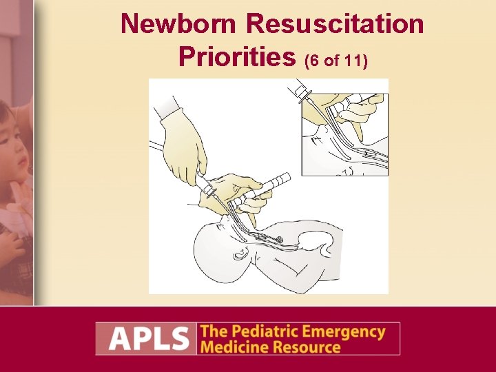 Newborn Resuscitation Priorities (6 of 11) Newborn Resuscitation Priorities (6 of 11)
