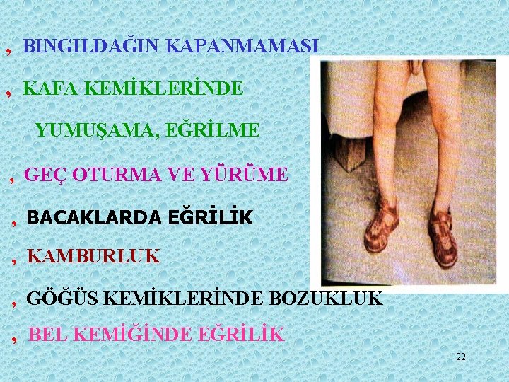 ‚ BINGILDAĞIN KAPANMAMASI ‚ KAFA KEMİKLERİNDE YUMUŞAMA, EĞRİLME ‚ GEÇ OTURMA VE YÜRÜME ‚