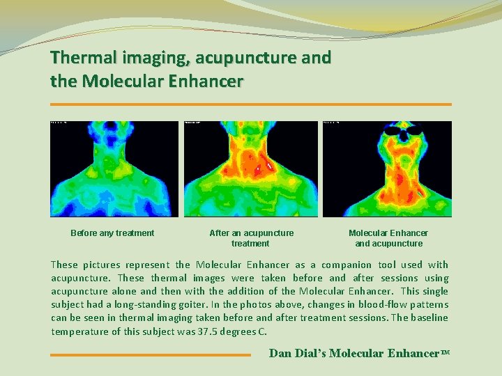 Thermal imaging, acupuncture and the Molecular Enhancer Before any treatment After an acupuncture treatment