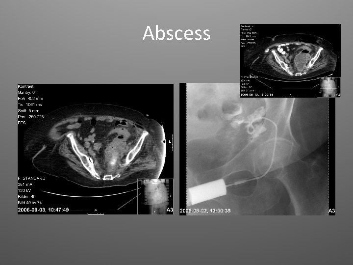 Abscess 