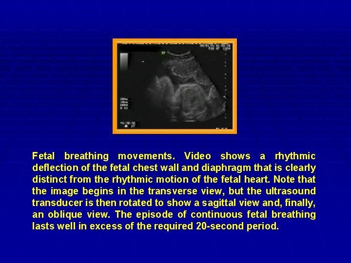 Fetal breathing movements. Video shows a rhythmic deflection of the fetal chest wall and