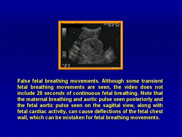 False fetal breathing movements. Although some transient fetal breathing movements are seen, the video