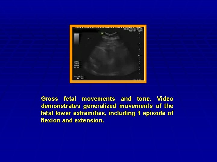 Gross fetal movements and tone. Video demonstrates generalized movements of the fetal lower extremities,