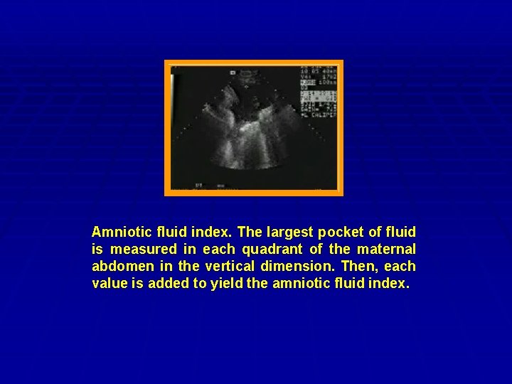 Amniotic fluid index. The largest pocket of fluid is measured in each quadrant of