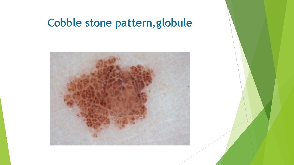 Cobble stone pattern, globule 