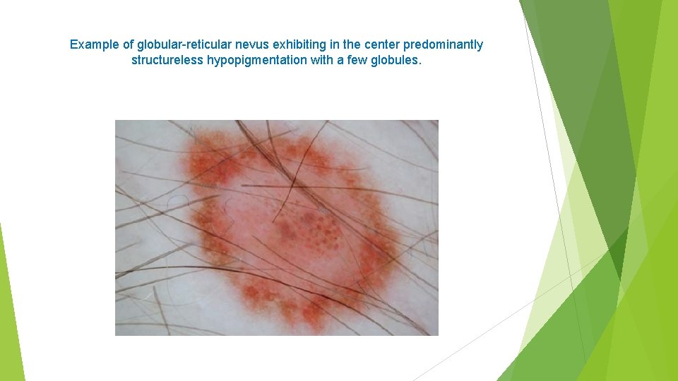 Example of globular-reticular nevus exhibiting in the center predominantly structureless hypopigmentation with a few