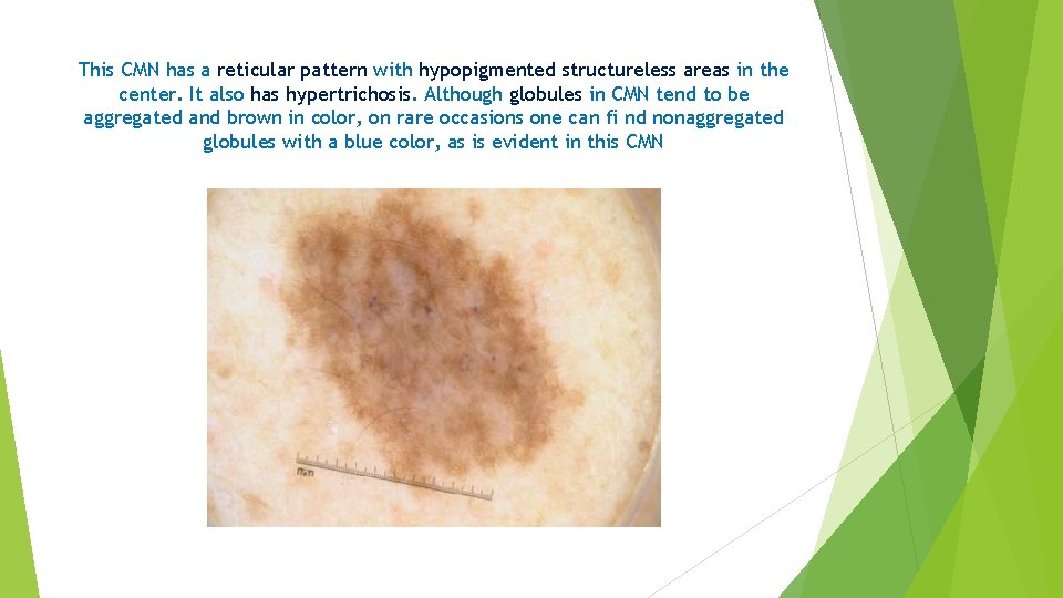 This CMN has a reticular pattern with hypopigmented structureless areas in the center. It