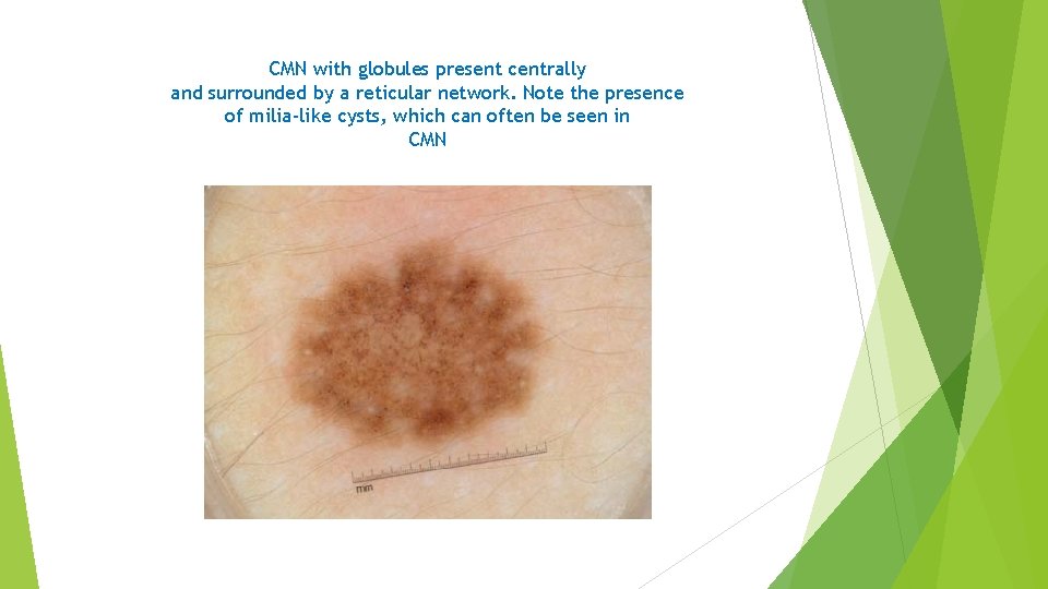 CMN with globules present centrally and surrounded by a reticular network. Note the presence
