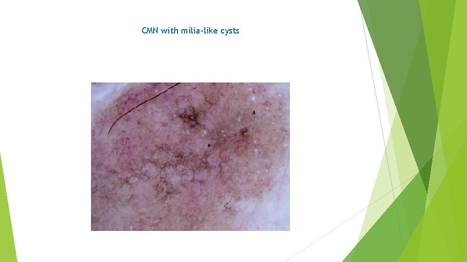 CMN with milia-like cysts 