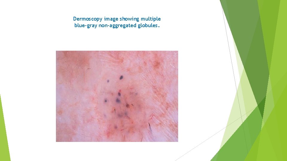 Dermoscopy image showing multiple blue-gray non-aggregated globules. 