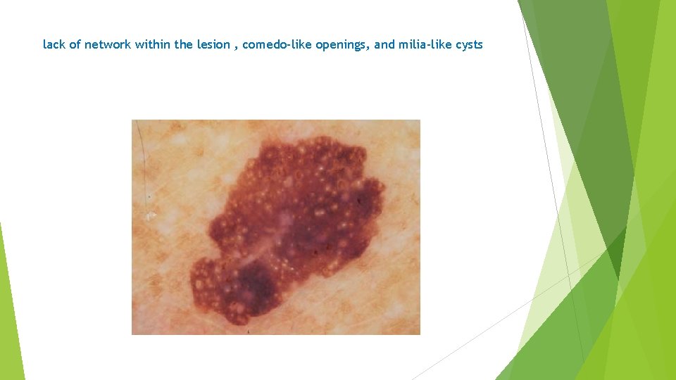 lack of network within the lesion , comedo-like openings, and milia-like cysts 
