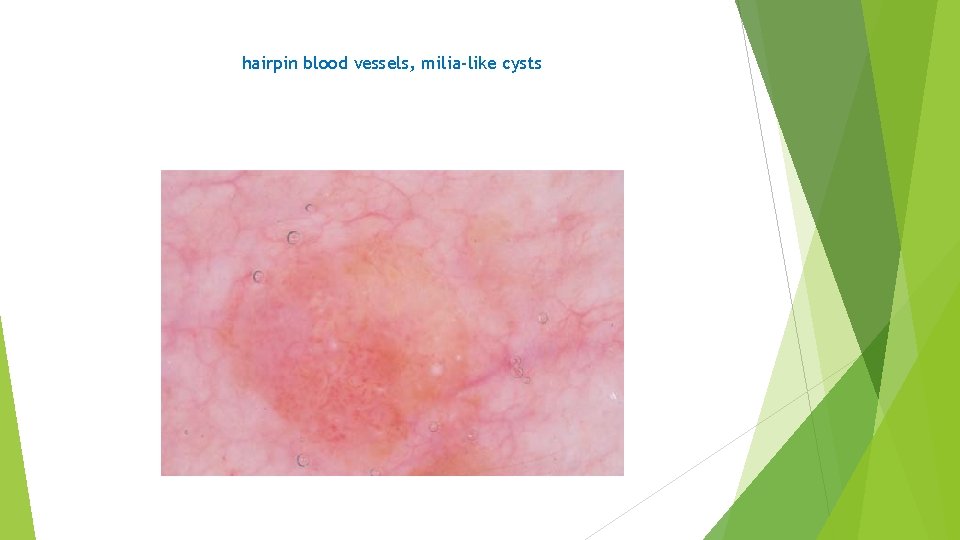 hairpin blood vessels, milia-like cysts 