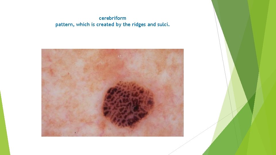 cerebriform pattern, which is created by the ridges and sulci. 