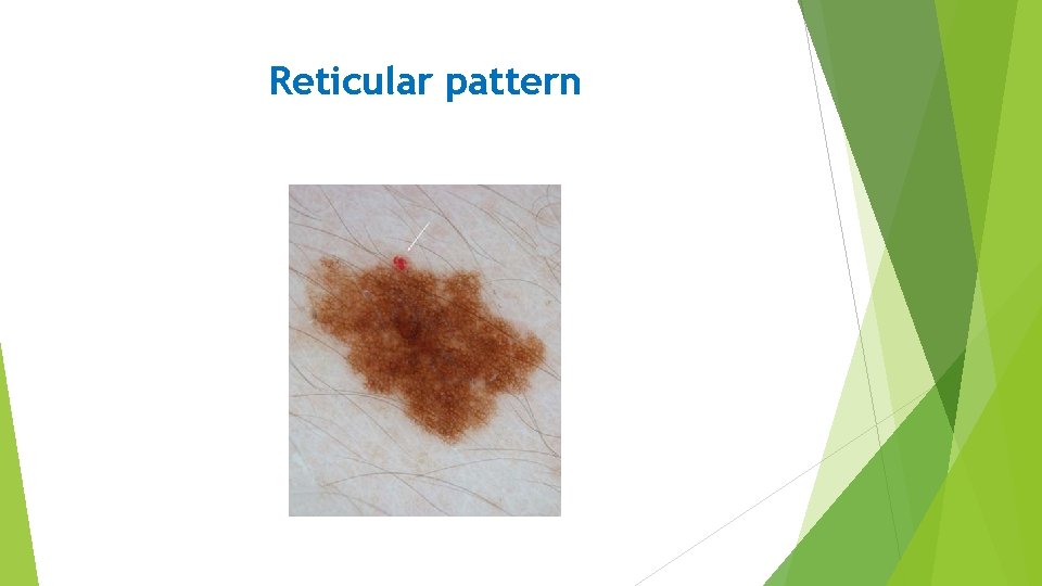 Reticular pattern 