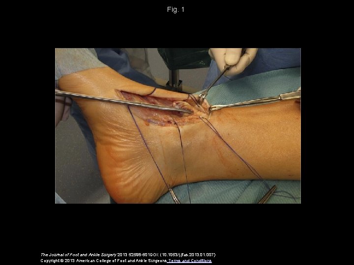 Fig. 1 The Journal of Foot and Ankle Surgery 2013 52598 -601 DOI: (10.