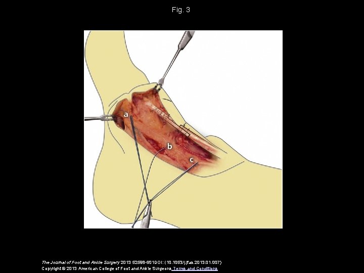 Fig. 3 The Journal of Foot and Ankle Surgery 2013 52598 -601 DOI: (10.